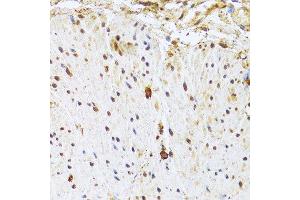 Immunohistochemistry of paraffin-embedded human rectal cancer using CDK4 Antibody. (CDK4 抗体  (AA 1-303))