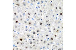 Immunohistochemistry of paraffin-embedded human liver cancer using LMX1B antibody at dilution of 1:200 (40x lens). (LMX1B 抗体)