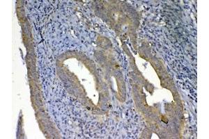 IHC testing of FFPE human rectal cancer tissue with UGT1A1 antibody at 1ug/ml.