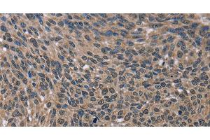 Immunohistochemistry of paraffin-embedded Human lung cancer using IMPDH2 Polyclonal Antibody at dilution of 1:60 (IMPDH2 抗体)