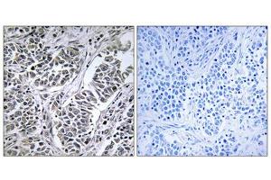 Immunohistochemistry analysis of paraffin-embedded human lung carcinoma tissue using ATP5D antibody. (ATP5F1D 抗体  (Internal Region))