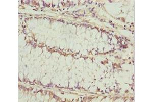 Immunohistochemistry of paraffin-embedded human colon cancer using ABIN7157472 at dilution of 1:100 (KERA 抗体  (AA 21-352))