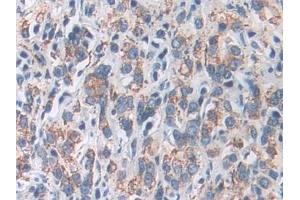 Detection of SOD2 in Human Prostate cancer Tissue using Polyclonal Antibody to Superoxide Dismutase 2, Mitochondrial (SOD2) (SOD2 抗体  (AA 25-222))