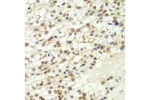 Immunohistochemistry of paraffin-embedded human kidney cancer using LHX4 antibody at dilution of 1:100 (x400 lens). (LHX4 抗体)