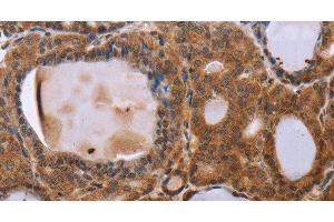 Immunohistochemistry of paraffin-embedded Human thyroid cancer using NDUFA2 Polyclonal Antibody at dilution of 1:30 (NDUFA2 抗体)