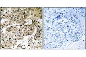 Immunohistochemistry analysis of paraffin-embedded human breast carcinoma, using HP1 alpha (Phospho-Ser92) Antibody. (CBX5 抗体  (pSer92))