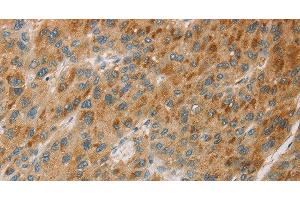 Immunohistochemistry of paraffin-embedded Human liver cancer tissue using CYP11B1 Polyclonal Antibody at dilution 1:30 (CYP11B1 抗体)