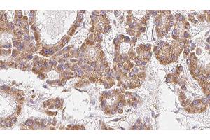 ABIN6279468 at 1/100 staining Human liver cancer tissue by IHC-P. (GNG12 抗体)