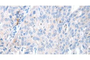 Immunohistochemistry of paraffin-embedded Human ovarian cancer using MAGEB4 Polyclonal Antibody at dilution of 1:40 (MAGEB4 抗体)