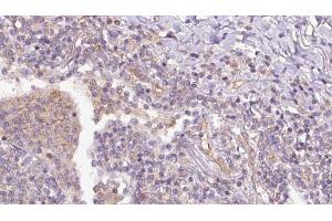 ABIN6273153 at 1/100 staining Human lymph cancer tissue by IHC-P. (RAP1B 抗体  (C-Term))