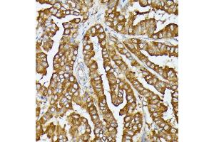 Immunohistochemistry of paraffin-embedded human thyroid cancer using COX15 antibody (ABIN7266634) at dilution of 1:100 (40x lens). (COX15 抗体  (AA 150-250))