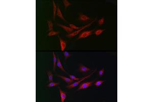 Immunohistochemistry of paraffin-embedded human lung cancer using DC Rabbit pAb (ABIN6132184, ABIN6139432, ABIN6139434 and ABIN6222532) at dilution of 1:150 (40x lens). (DCAF7 抗体  (AA 1-342))