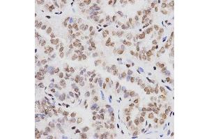 Immunohistochemistry of paraffin-embedded human thyroid cancer tissue using H3K4me1 antibody at dilution of 1:200 (x401 lens). (Histone 3 抗体  (H3K4me))