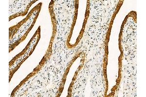 ABIN6261209 and ABIN6268652 at 1/100 staining Human ovarian cancer and adjacent normal tissues by IHC-P. (Cytokeratin 19 抗体  (C-Term))