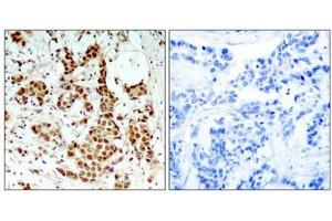 Immunohistochemical analysis of paraffin-embedded human breast carcinoma tissue using p90RSK(Phospho-Thr348) Antibody(left) or the same antibody preincubated with blocking peptide(right). (RPS6KA1 抗体  (pThr348))