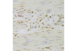 Immunohistochemistry of paraffin-embedded human gastric cancer using PRPF3 Antibody (ABIN5973192) at dilution of 1/100 (40x lens). (PRPF3 抗体)