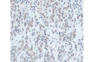 Immunohistochemistry of paraffin-embedded Human gastric cancer using ZNF703 Polyclonal Antibody at dilution of 1:100 (40x lens). (ZNF703 抗体)
