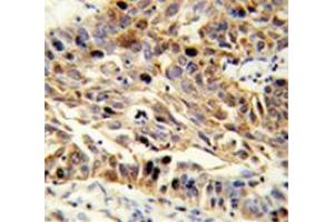 Immunohistochemistry analysis in human lung carcinoma (Formalin-fixed, Paraffin-embedded) using Fibulin-3 Antibody (N-term), followed by peroxidase-conjugated  secondary antibodyand DAB staining. (FBLN3 抗体  (N-Term))