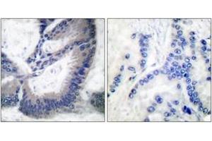 Immunohistochemistry analysis of paraffin-embedded human lung carcinoma tissue, using iNOS Antibody.