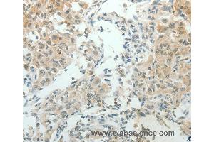 Immunohistochemistry of Human lung cancer using NDRG2 Polyclonal Antibody at dilution of 1:50 (NDRG2 抗体)