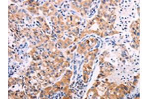 The image on the left is immunohistochemistry of paraffin-embedded Human lung cancer tissue using ABIN7131322(TEKT4 Antibody) at dilution 1/20, on the right is treated with fusion protein. (Tektin 4 抗体)