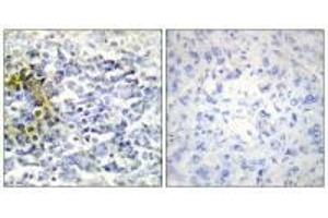 Immunohistochemistry analysis of paraffin-embedded human lung carcinoma tissue using FXR2 antibody. (FXR2 抗体)