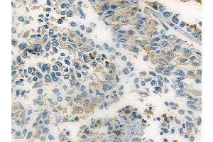 ABIN6257653 and ABIN6273822 at 1/100 staining human lung squamous cell carcinoma by IHC-P.