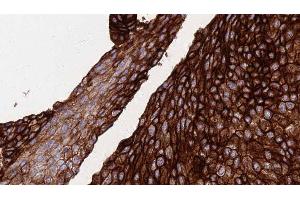 ABIN6276377 at 1/100 staining Human urothelial cancer tissue by IHC-P. (Fatty Acid Synthase 抗体  (N-Term))