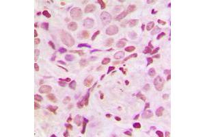 Immunohistochemical analysis of SRF (pS103) staining in human breast cancer formalin fixed paraffin embedded tissue section. (SRF 抗体  (pSer103))