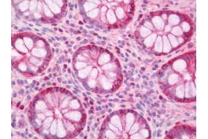 Immunohistochemistry (Paraffin-embedded Sections) (IHC (p)) image for anti-Cadherin 1, Type 1, E-Cadherin (Epithelial) (CDH1) antibody (ABIN2618877)