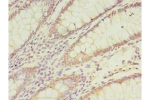 Immunohistochemistry of paraffin-embedded human colon cancer using ABIN7171437 at dilution of 1:100 (CCT6B 抗体  (AA 101-330))
