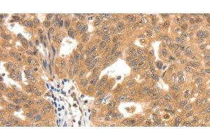 Immunohistochemistry of paraffin-embedded Human ovarian cancer tissue using SCN5A Polyclonal Antibody at dilution 1:30 (SCN5A 抗体)