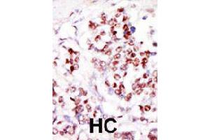 Formalin-fixed and paraffin-embedded human hepatocellular carcinoma tissue reacted with TLK1 polyclonal antibody  , which was peroxidase-conjugated to the secondary antibody, followed by DAB staining. (TLK1 抗体  (C-Term))