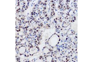 Immunohistochemistry of paraffin-embedded human thyroid cancer using EZH2/KMT6 Rabbit pAb (ABIN6133511, ABIN6140395, ABIN6140399 and ABIN6221414) at dilution of 1:100 (40x lens). (EZH2 抗体  (AA 1-250))