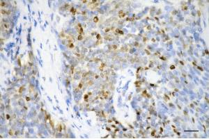 Immunohistochemistry was performed on paraffin-embedded human breast carcinoma using proliferating cell nuclear antigen antibody (ABIN7799914), 1:200). (PCNA 抗体)