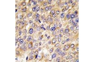 IHC analysis of FFPE human hepatocarcinoma tissue stained with GABARAP antibody