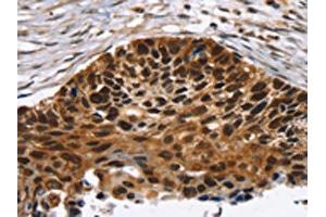 The image on the left is immunohistochemistry of paraffin-embedded Human esophagus cancer tissue using ABIN7192726(TACC2 Antibody) at dilution 1/30, on the right is treated with synthetic peptide. (TACC2 抗体)