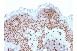 Formalin-fixed, paraffin-embedded human Basal Cell Carcinoma stained with Emerin Mouse Monoclonal Antibody (EMD/2167). (Emerin 抗体  (AA 56-167))