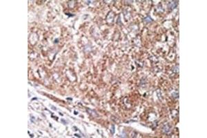 IHC analysis of FFPE human hepatocarcinoma tissue stained with the Nestin antibody (Nestin 抗体  (AA 1560-1590))