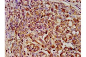 IHC image of ABIN7169341 diluted at 1:600 and staining in paraffin-embedded human pancreatic cancer performed on a Leica BondTM system. (SERPINB4 抗体  (AA 128-208))