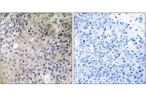 Immunohistochemistry analysis of paraffin-embedded human lung carcinoma tissue, using SHC3 Antibody. (SHC3 抗体  (AA 291-340))