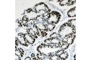 Immunohistochemical analysis of HBP1 staining in human colon cancer formalin fixed paraffin embedded tissue section. (HBP1 抗体  (C-Term))