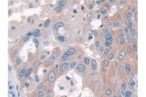 Detection of FUT6 in Human Breast cancer Tissue using Polyclonal Antibody to Fucosyltransferase 6 (FUT6) (FUT6 抗体  (AA 35-359))