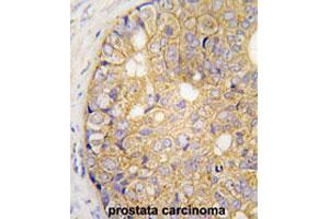 Formalin-fixed and paraffin-embedded human prostate carcinomareacted with GJB6 polyclonal antibody , which was peroxidase-conjugated to the secondary antibody, followed by AEC staining.