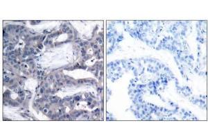 Immunohistochemical analysis of paraffin- embedded human breast carcinoma tissue using MEK2 (phospho-Thr394) antibody (E011008). (MEK2 抗体  (pThr394))