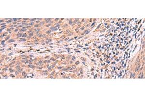 Immunohistochemistry of paraffin-embedded Human cervical cancer tissue using PER3 Polyclonal Antibody at dilution of 1:55(x200) (PER3 抗体)
