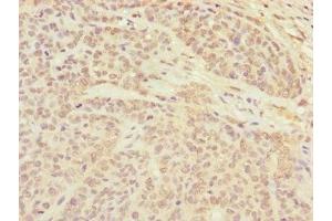 Immunohistochemistry of paraffin-embedded human ovarian cancer using ABIN7147357 at dilution of 1:100 (CETN3 抗体  (AA 1-167))