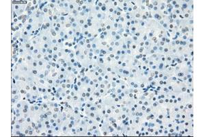 Immunohistochemical staining of paraffin-embedded Adenocarcinoma of breast tissue using anti-FCGR2A mouse monoclonal antibody. (FCGR2A 抗体)
