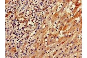 Immunohistochemistry of paraffin-embedded human liver cancer using ABIN7168819 at dilution of 1:100 (SEMA6A 抗体  (AA 755-990))