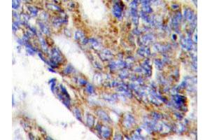 Immunohistochemical analysis of paraffin-embedded human colon cancer tissue using COL1A2 polyclonal antibody . (COL1A2 抗体)